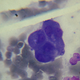 Illustration for article titled Cancer is just as deadly as it was 50 years ago. Heres why thats about to change.